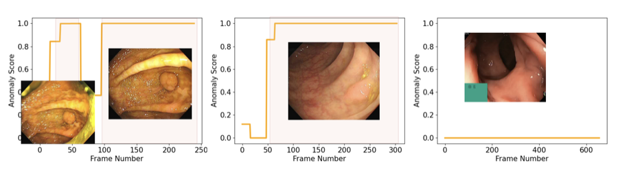Colonoscopy Video Dataset preview